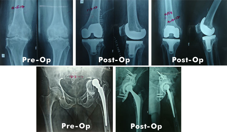 Hip and Knee Replacement Surgeries