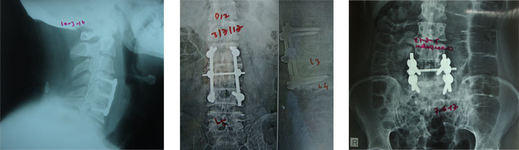 Spine Surgery