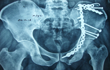 Pelvi Acetabular Surgeries